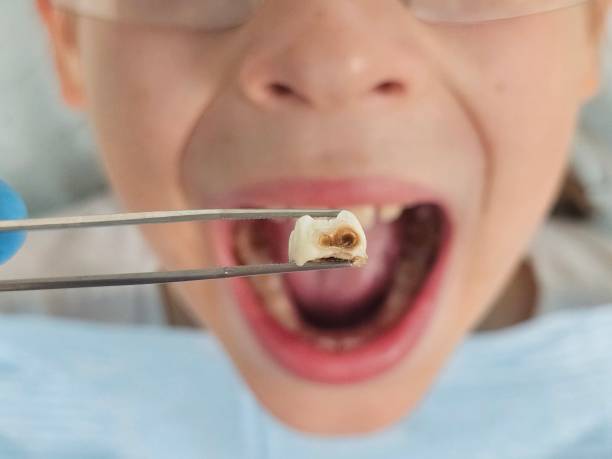 Best Emergency Tooth Extraction in Jacksboro, TX